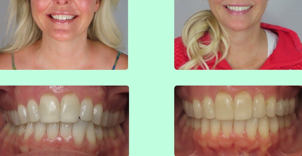 Adult Invisalign patient, 13 months in treatment